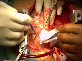 Open Heart Surgery 2